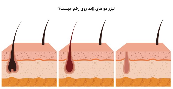لیزر مو های زائد روی زخم چیست؟ همه چیز در مورد لیزر مو